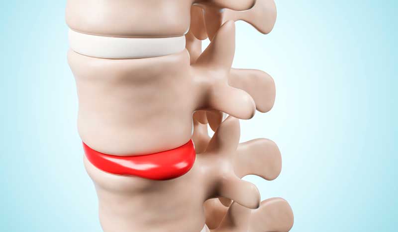 Causes Spinal Disc Herniations - What Causes Spinal Disc Herniations