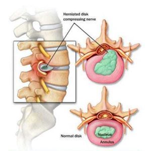 Back Pain – Symptoms