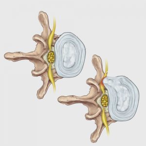 Conditions - Disc Protrusions herniations