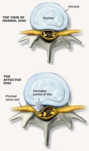 Disc Protrusions and Herniations – Disc Herniations
