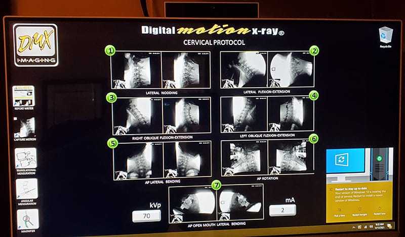 (DMX) Digital Motion X-ray - Cervical Protocol