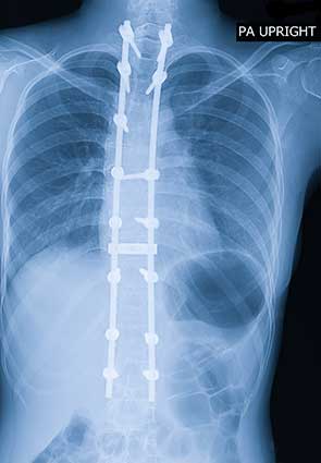 Comprensión de la escoliosis y los objetivos de la atención - ¿Cuál es el efecto de la cirugía en la calidad de vida del adolescente con escoliosis idiopática adolescente?