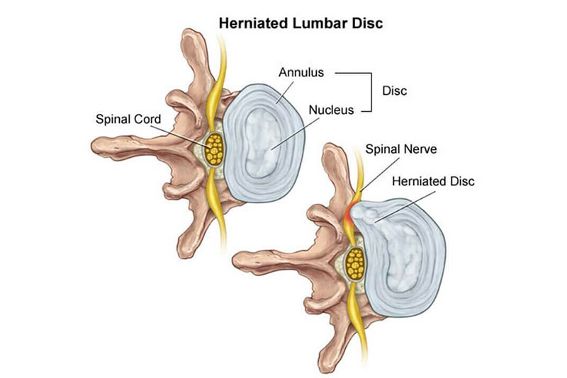What Causes Spinal Disc Damage Herniations, Bulges, Protrusions, Extrusion, Sequestered? - What Causes Spinal Disc Damage Herniations, Bulges, Protrusions, Extrusion, Sequestered?