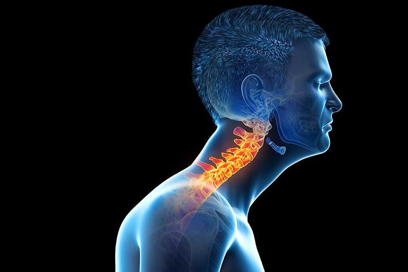 forward head syndrome - forward head syndrome