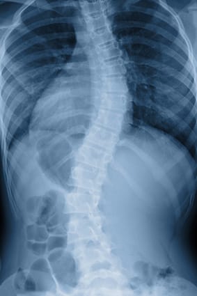 Sunset Chiropractic & Wellness Research Review: Analysis of sagittal curvature and its influencing factors in adolescent idiopathic scoliosis - adolescent idiopathic scoliosis