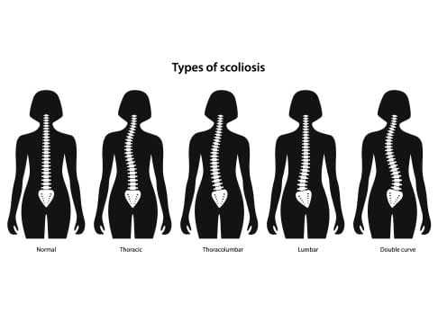 Scoliosis Treatment Without Bracing or Surgery - Scoliosis therapy offers these benefits to scoliosis patients