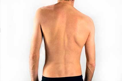 Sunset Chiropractic & Wellness Research Review: Association Between Incorrect Posture and Scoliosis - Posture is the window to the spine and nervous system. Any abnormal postures represent damage or weakened areas of your spine