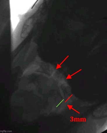 The Best Test For Cervical Ligament Instability? DMX? -What are the most common symptoms of cervical ligament damage?