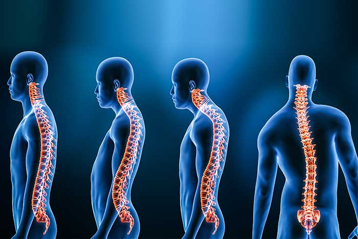 Neurology of Posture, Spinal Alignment, and Scoliosis - Neurology of Posture, Spinal Alignment, and Scoliosis.