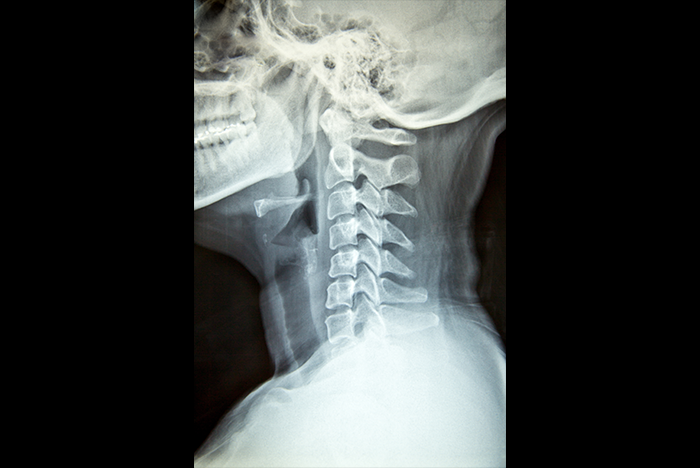 Correlative analysis of cervical curvature and atlantoaxial instability - Correlative analysis of cervical curvature and atlantoaxial instability
