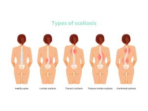 Rethinking Scoliosis - Rethinking Scoliosis