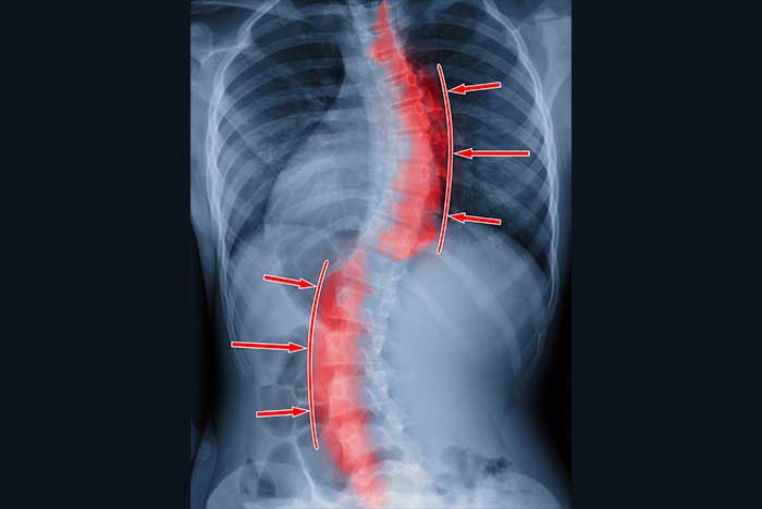 La relación de la asimetría de la carga de la cadera y los parámetros radiológicos de la columna vertebral en la escoliosis idiopática tipo 1 de Lenke - La relación de la asimetría de la carga de la cadera y los parámetros radiológicos de la columna vertebral en la escoliosis idiopática tipo 1 de Lenke