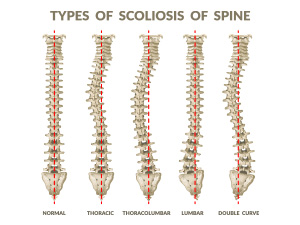 recognition of thoracic hypokyphosis and therapeutic implications - Sunset Chiropractic & Wellness Research Review