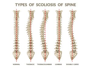 recognition of thoracic hypokyphosis and therapeutic implications - Sunset Chiropractic & Wellness Research Review