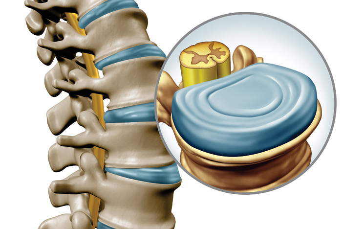 Sunset Chiropractic & Wellness Research Review: Biomechanical effect of C5-C6 intervertebral disc degeneration on the human lower cervical spine (C3-C7): a finite element study.Thee biomechanical effects of intervertebral discs and facet joints degeneration on the cervical spine are essential to understanding the mechanisms of spinal disorders to improve pathological and clinical treatment.
