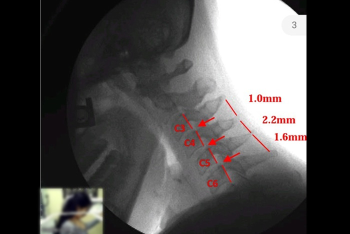 ¿Cómo puede (DMX) Digital Motion X-ray detectar daños en los ligamentos?