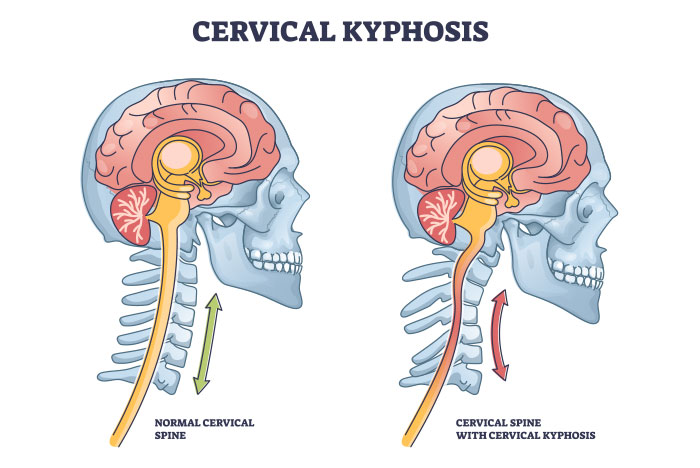 Sunset Chiropractic & Wellness Review: Incidence of cervical kyphosis and cervical osterior translation in neck pain associated with radiological evidence of degenerative disc disease. Cervical kyphosis was present in 60% of patients with radiologically evident degenerative disc disease, with C5 showing the most posterior displacement