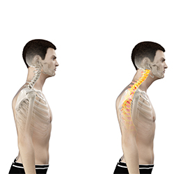 Sunset Chiropractic & Wellness Research Review: Does Improvement towards a Normal Cervical Sagittal Configuration Aid in the Management of Lumbosacral Radiculopathy: A Randomized Controlled Trial. Participants included 80 (35 female) patients between 40 and 55 years experiencing CDLR with a definite hypolordotic cervical spine and forward head posture (FHP) and were randomly assigned a comparative treatment control group and a study group.