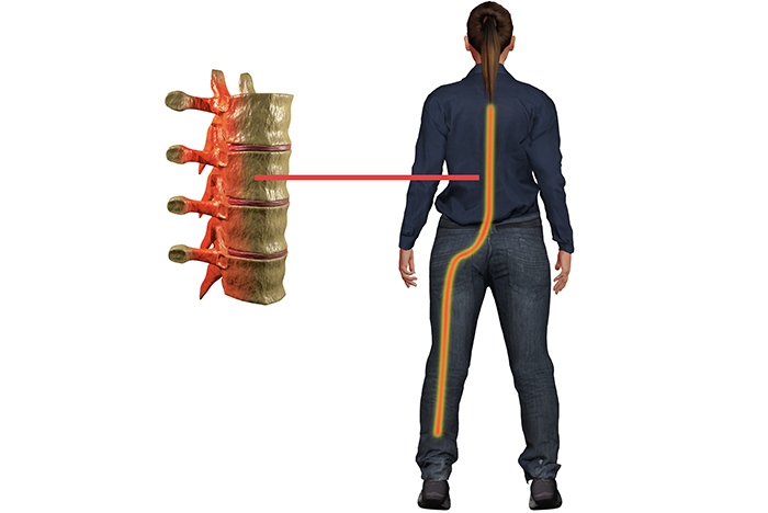 Sunset Chiropractic & Wellness Research Review:¿ La mejora hacia una configuración sagital cervical normal ayuda en el manejo de la radiculopatía lumbosacra?: Se realizó un estudio controlado aleatorio con un seguimiento de seis meses para investigar los efectos de la corrección de la postura de la cabeza sagital en los parámetros de la postura de la columna en 3D, el dolor de espalda y piernas, la discapacidad y la función de la raíz nerviosa S1 en pacientes con radiculopatía lumbosacra discogénica crónica (CDLR ).