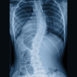Sunset Chiropractic & Wellness: Scoliosis Diagnosis and Traditional Treatment Model. A measurement of 10 degrees or higher is classified as scoliosis.