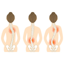 Sunset Chiropractic & Wellness: Scoliosis Diagnosis and Traditional Treatment Model. Scoliosis is defined by a one dimensional measurement on x-ray called a Cobb angle