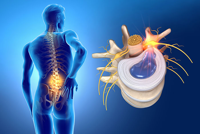 Sunset Chiropractic & Wellness Research Review: Pain Recurrence after Discectomy for Symptomatic Lumbar Disc Herniation. Recurrence of leg pain and LBP is common after discectomy for SLDH.