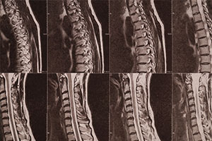 Sunset Chiropractic and Wellness. Loss of Cervical Lordosis Causing Disc Herniation? Cervical lordosis is a natural curvature of the spine that occurs in the neck. It is caused by the alignment of the vertebrae in the neck, which are stacked on top of each other in a way that creates a curve. This curve helps to support the weight of the head and neck.