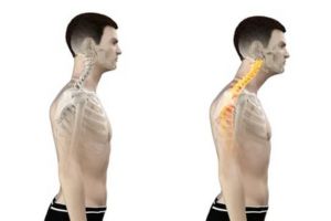 Sunset Chiropractic and Wellness. Headaches Caused by Loss of Normal Cervical Lordosis and Forward Head Posture. Cervical lordosis helps to support the weight of the head and to protect the spinal cord.